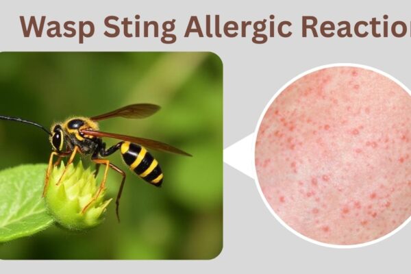 Wasp Sting Allergic Reaction