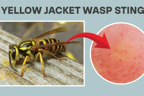 Yellow Jacket Wasp Sting: Symptoms, Id, & Treatment Guide Yellow Jacket Wasp Sting: Symptoms, Id, & Treatment Guide