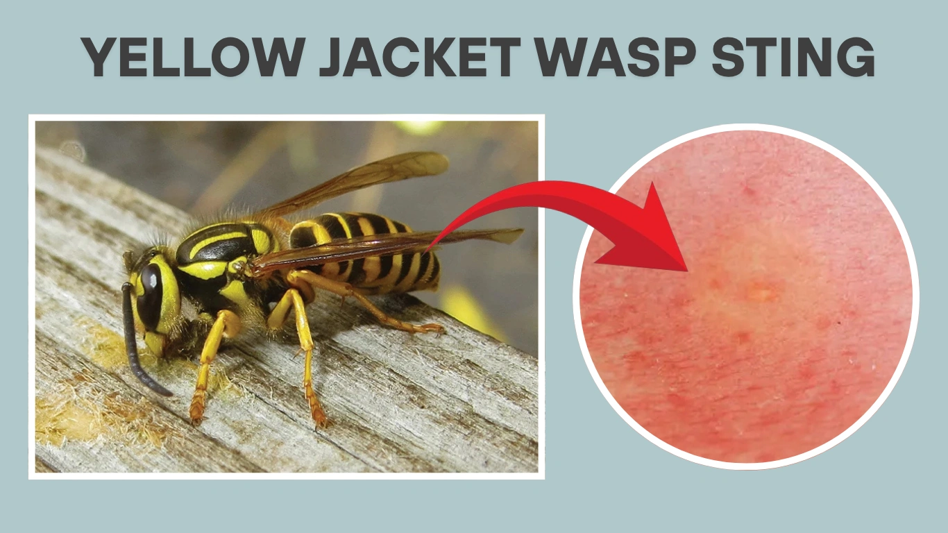 Yellow Jacket Wasp Sting: Symptoms, Id, & Treatment Guide