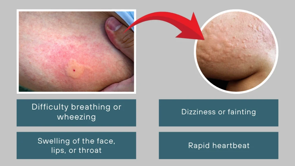 Monitor for Allergic Reactions