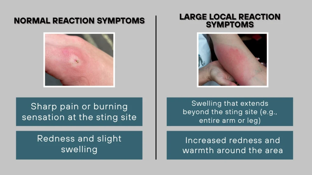 Symptoms of a Wasp Sting