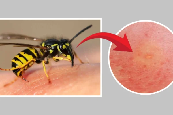 Wasp Sting Symptoms, Pictures, Identification, & Treatment