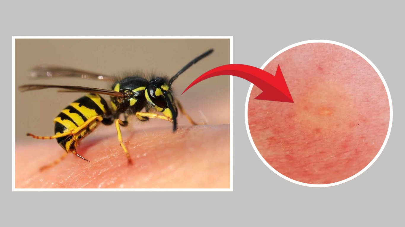 Wasp Sting Symptoms, Pictures, Identification, & Treatment