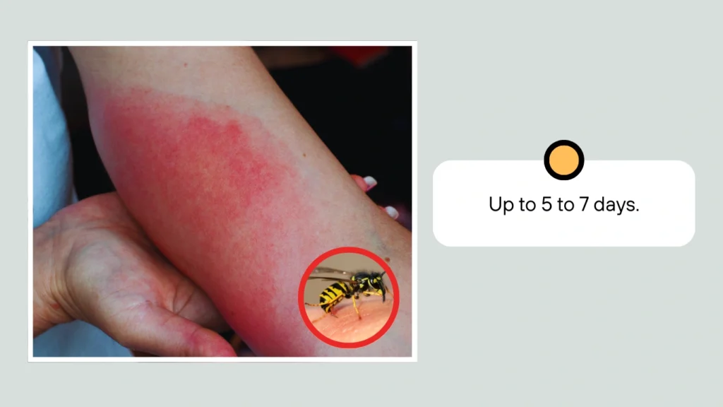 How Long Does a Wasp Sting Stay Swollen