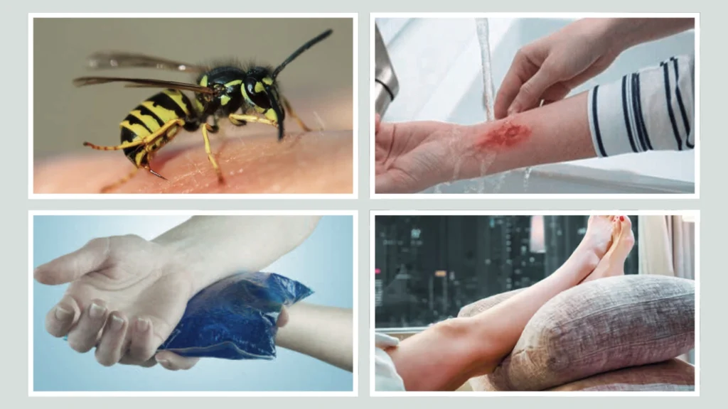 Immediate First Aid for a Wasp Sting