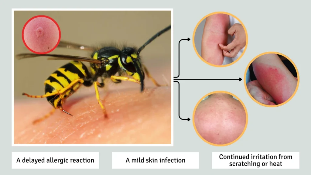 Is It Normal for a Wasp Sting to Itch or Swell After a Week