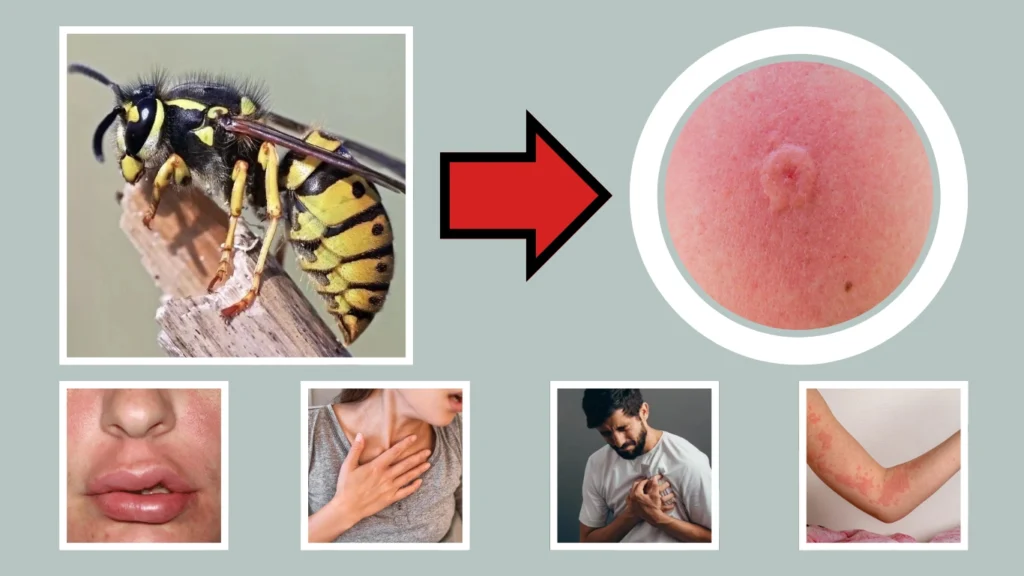 Severe Allergic Reactions (Anaphylaxis)