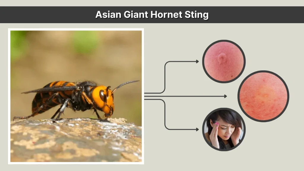 Asian Giant Hornet Sting