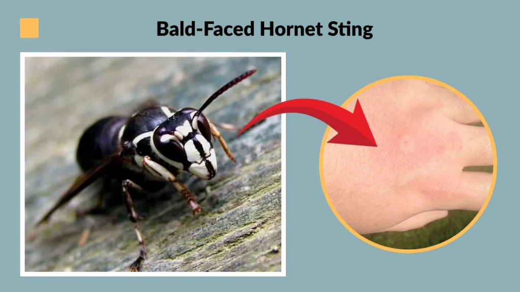Bald-Faced Hornet Sting