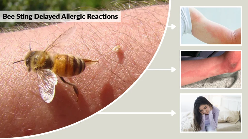 Bee Sting Delayed Allergic Reactions