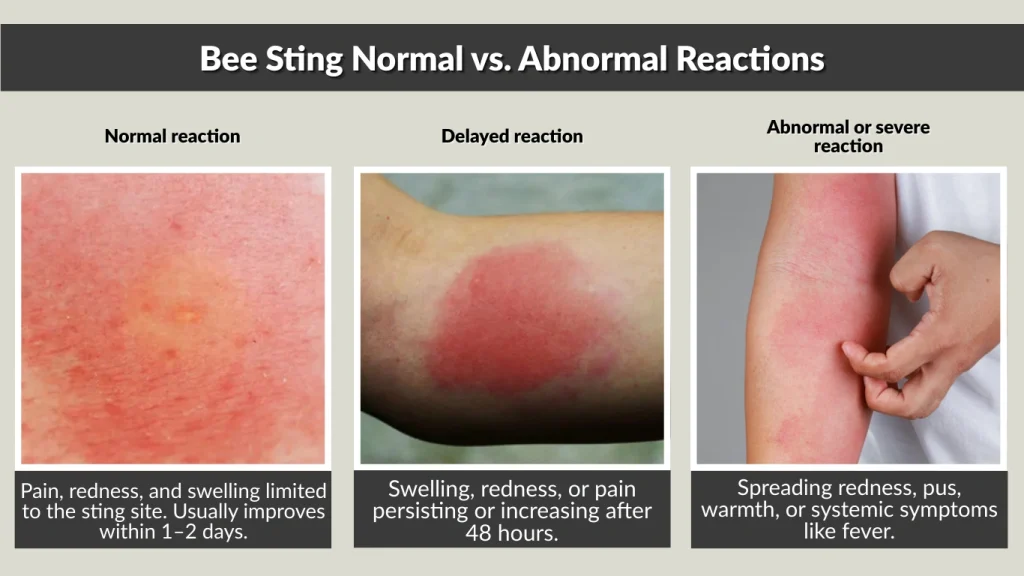 Bee Sting Normal vs. Abnormal Reactions