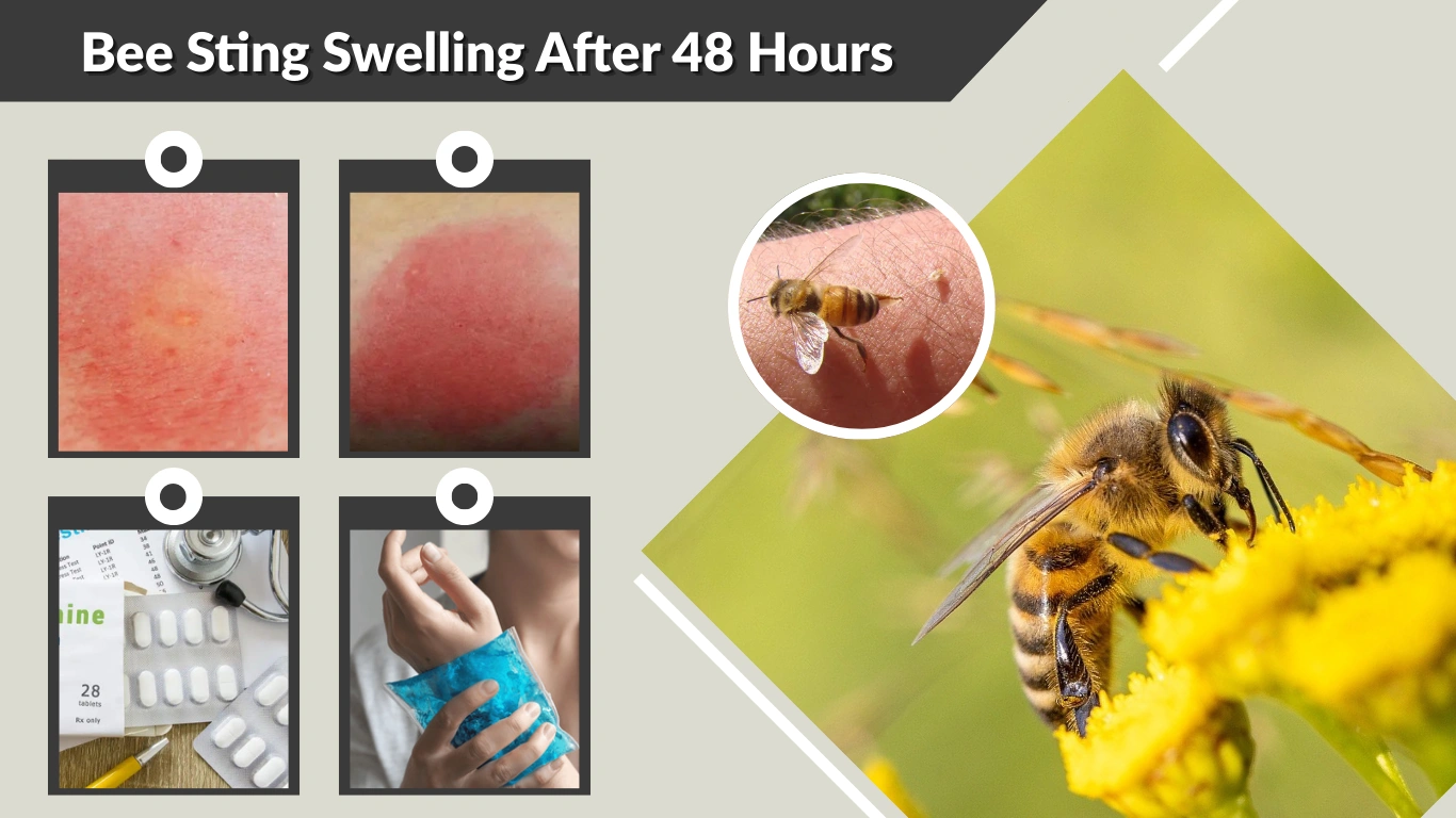 Bee Sting Swelling After 48 Hours Causes, Risks, and Treatment