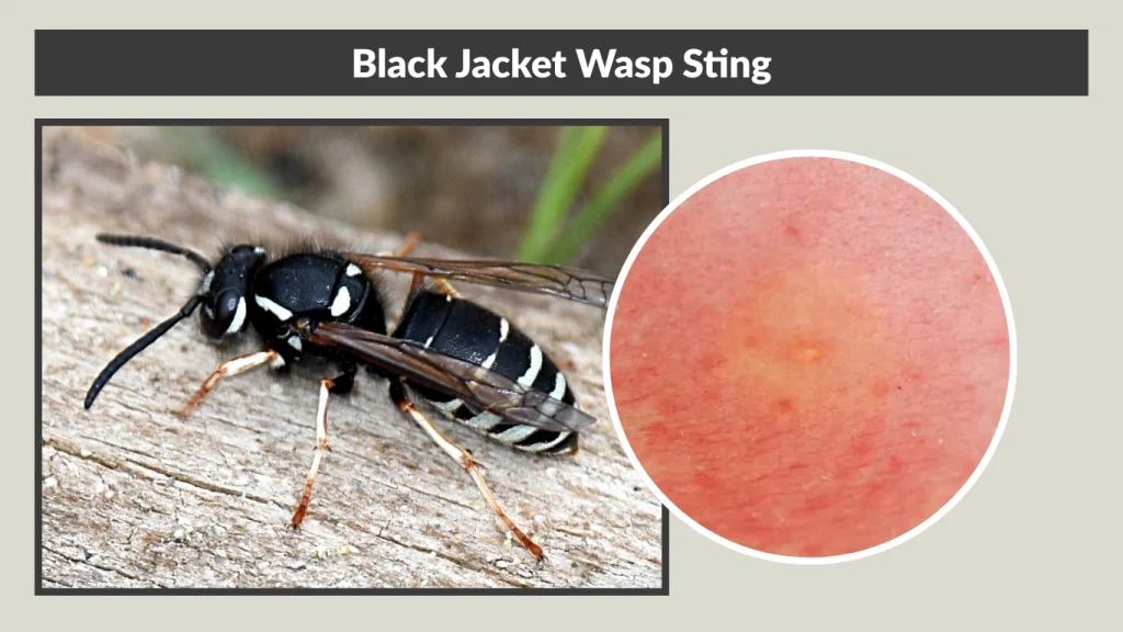 Black Jacket Wasp Sting