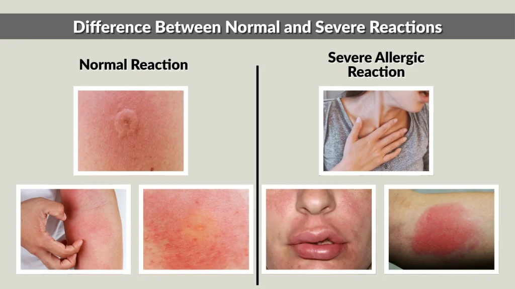 Difference Between Normal and Severe Reactions