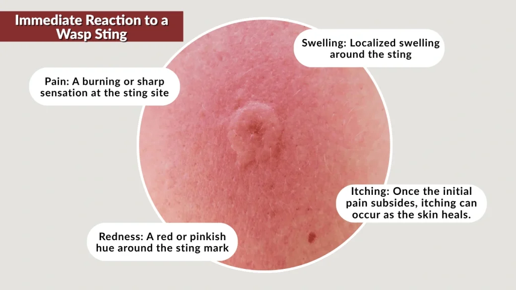 Immediate Reaction to a Wasp Sting