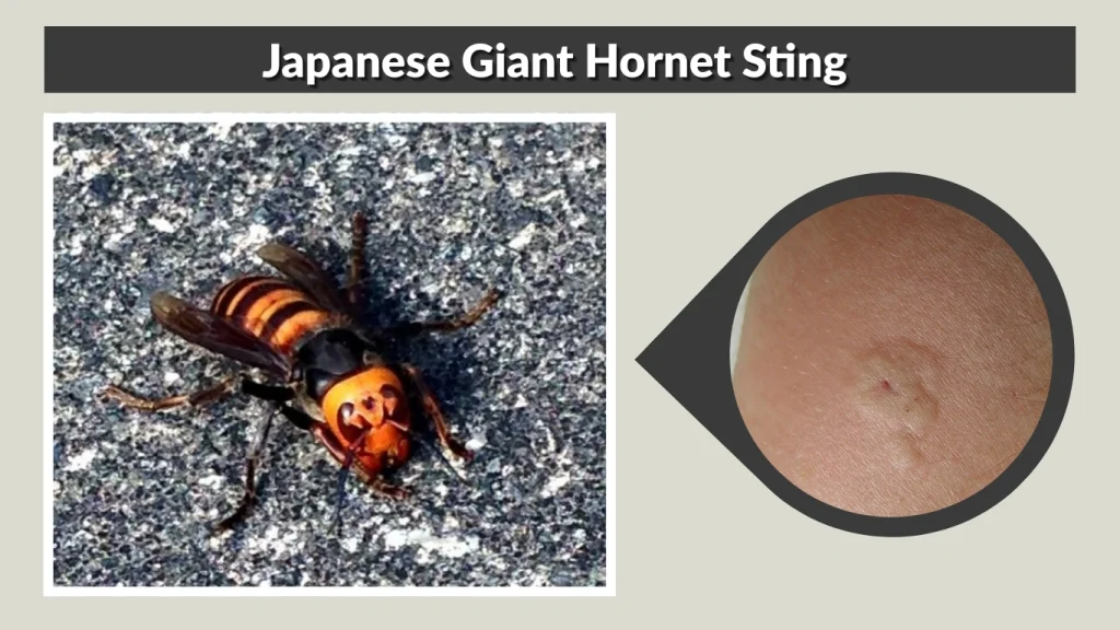 Japanese Giant Hornet Sting
