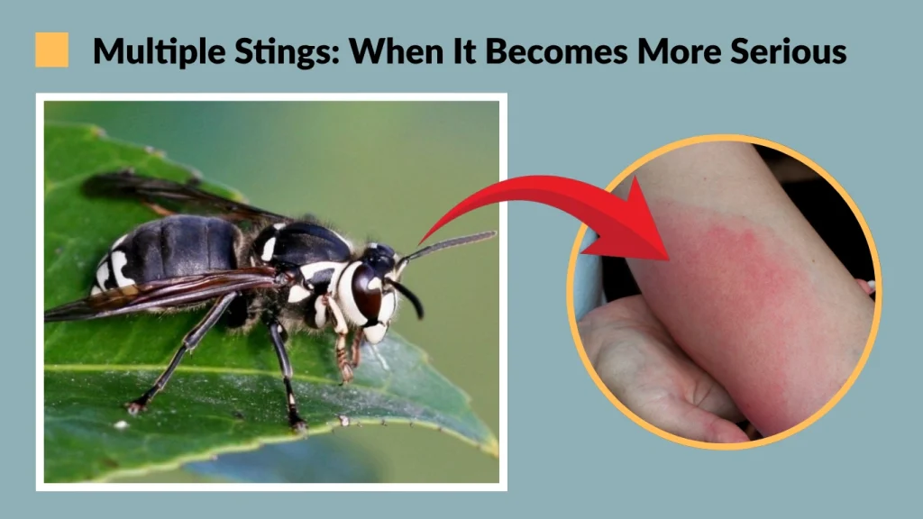 Multiple Stings When It Becomes More Serious