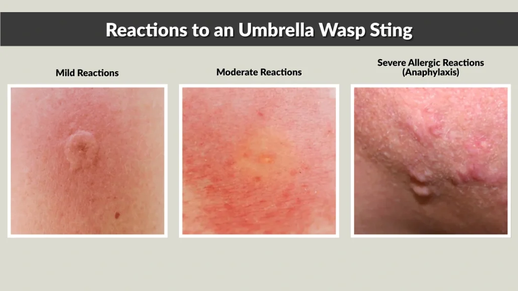 Reactions to an Umbrella Wasp Sting