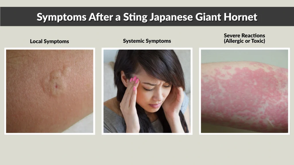 Symptoms After a Sting Japanese Giant Hornet