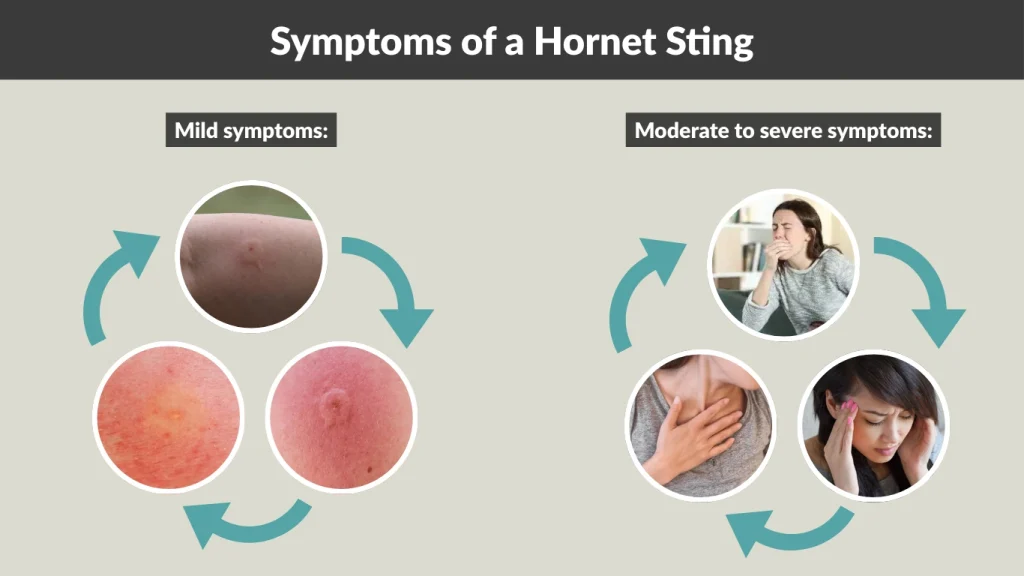 Symptoms of a Hornet Sting