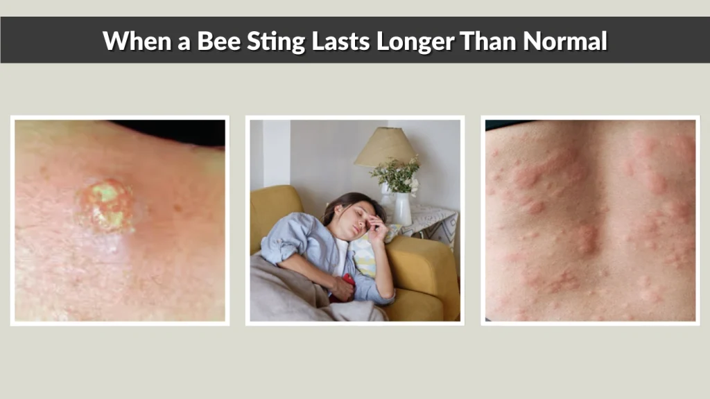 When a Bee Sting Lasts Longer Than Normal