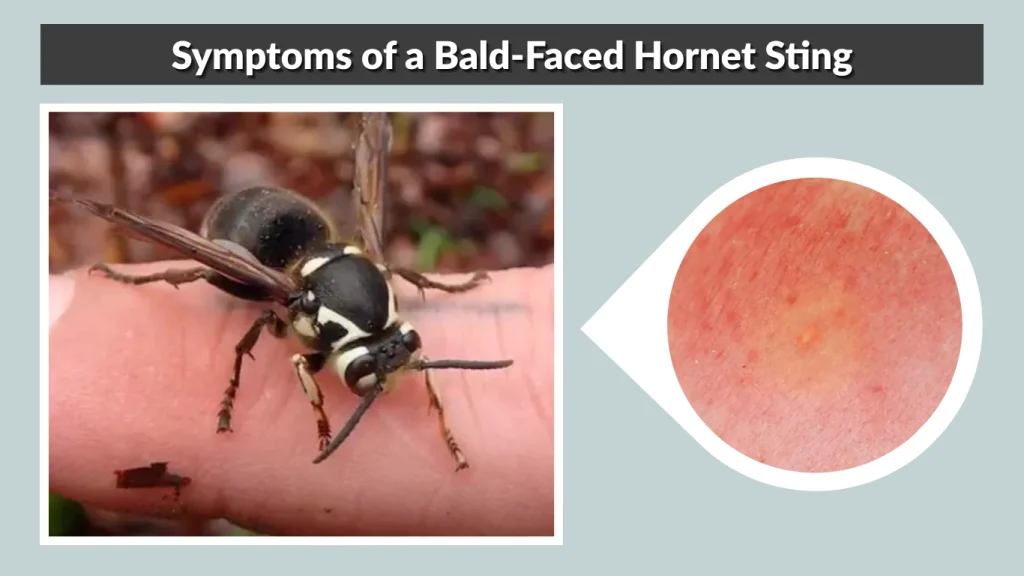 Symptoms of a Bald-Faced Hornet Sting
