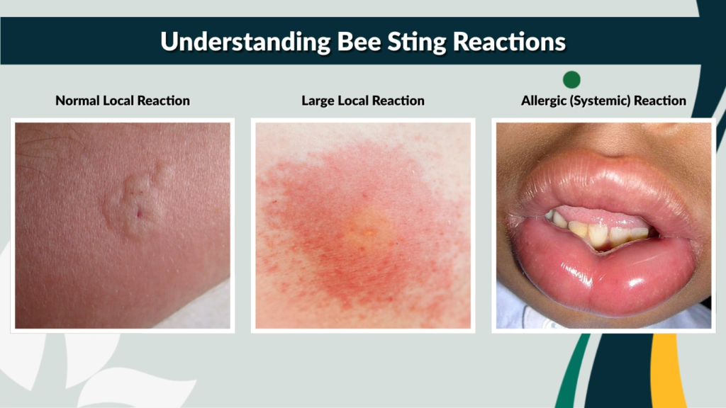 Understanding Bee Sting Reactions