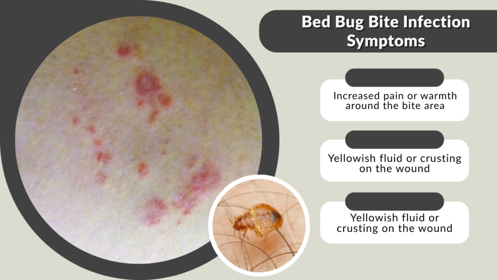 Bed Bug Bite Infection Symptoms