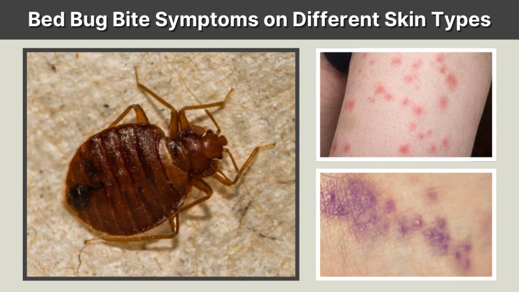 Bed Bug Bite Symptoms on Different Skin Types