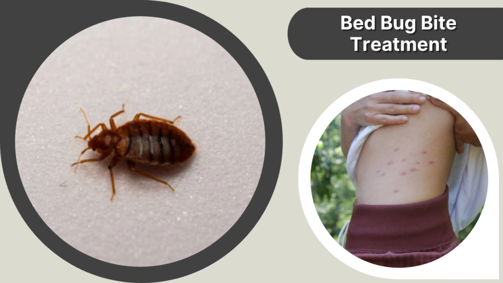 Bed Bug Bite Treatment
