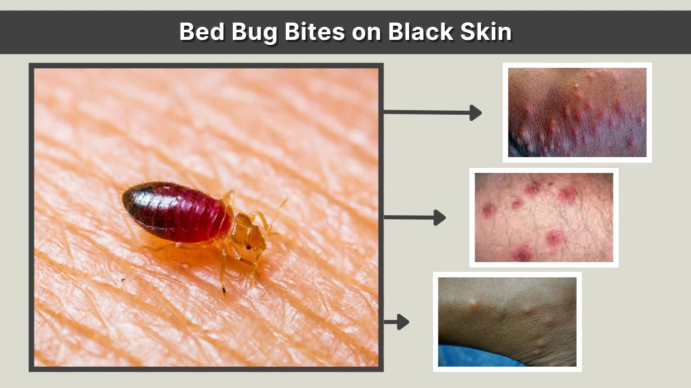 Bed Bug Bites on Black Skin: Identification, Pictures, and Treatment