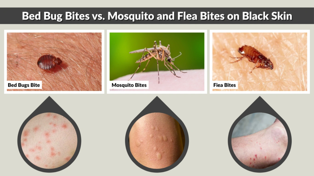 Bed Bug Bites vs. Mosquito and Flea Bites on Black Skin