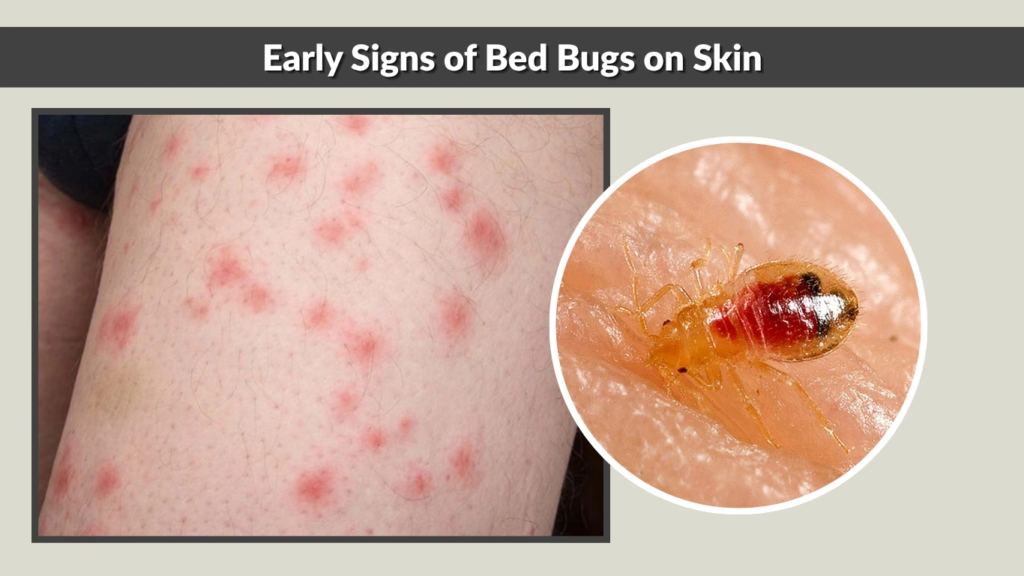 Early Signs of Bed Bugs on Skin