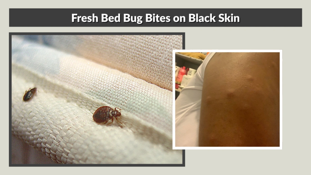Fresh Bed Bug Bites on Black Skin