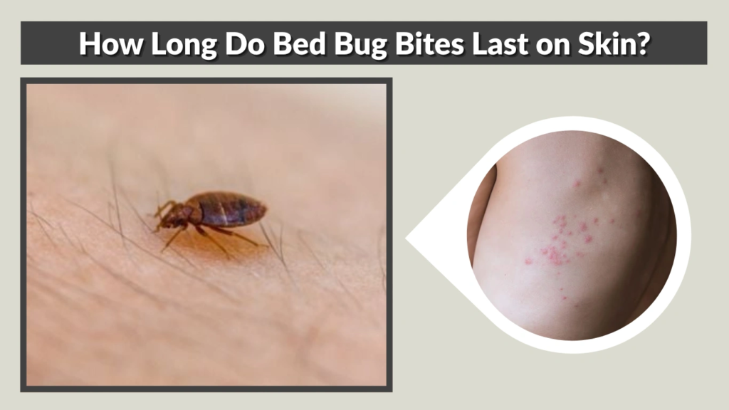 How Long Do Bed Bug Bites Last on Skin