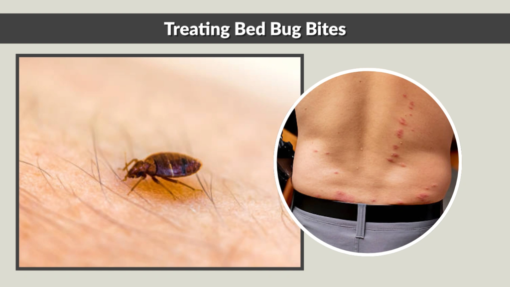 Treating Bed Bug Bites