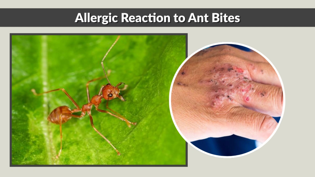 Allergic Reaction to Ant Bites