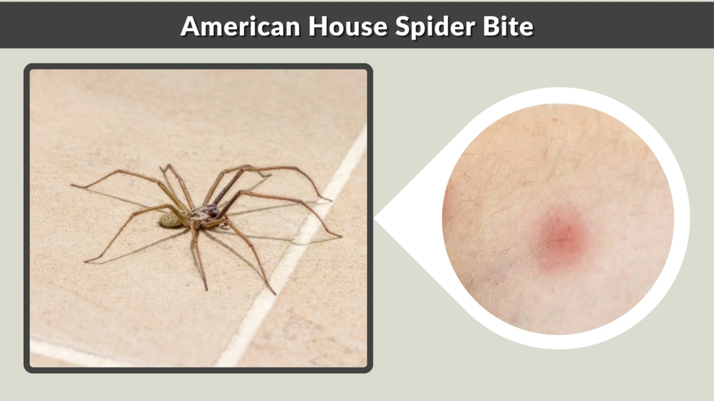 American House Spider Bite
