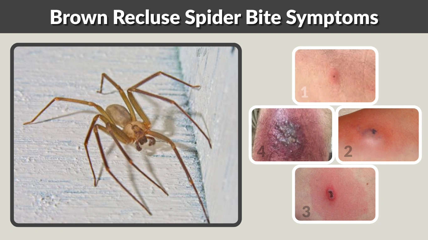 Brown Recluse Spider Bite Symptoms A Complete In-Depth Guide