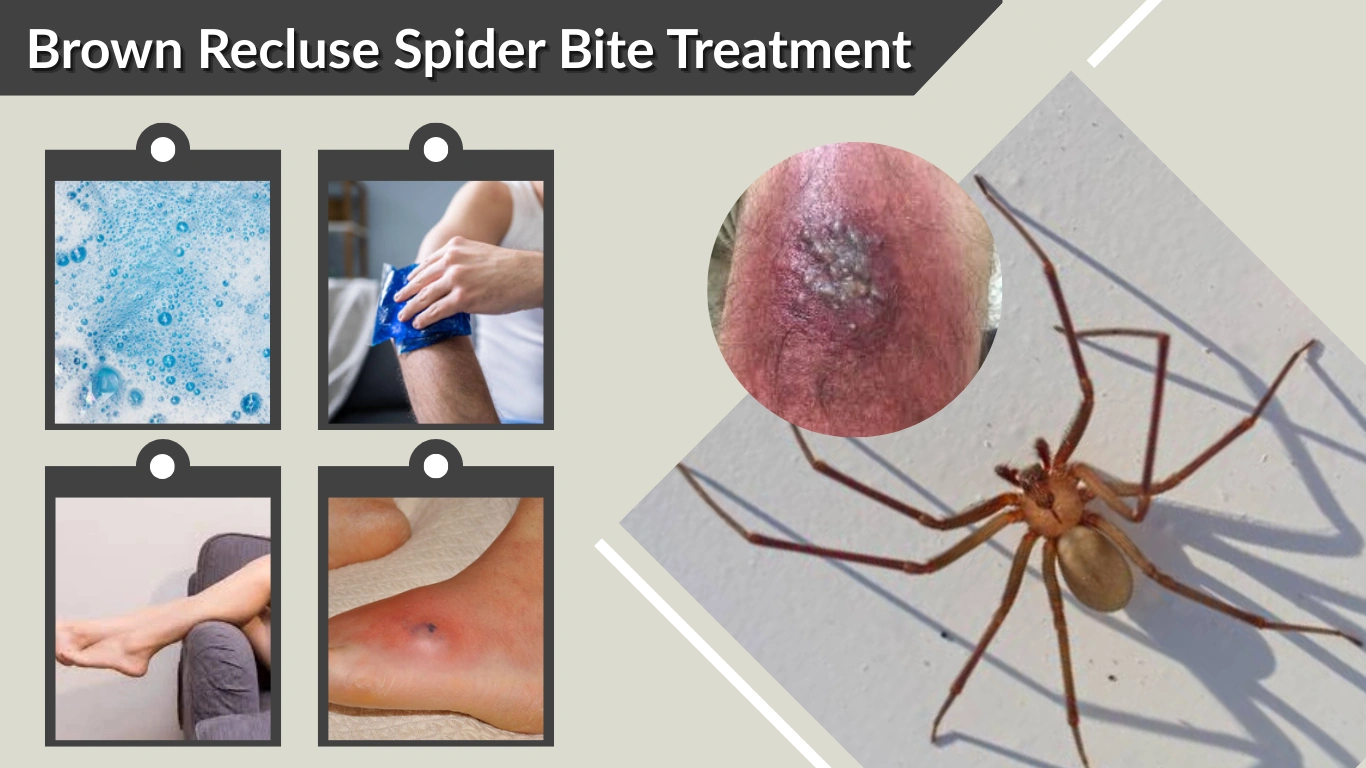 Brown Recluse Spider Bite Treatment