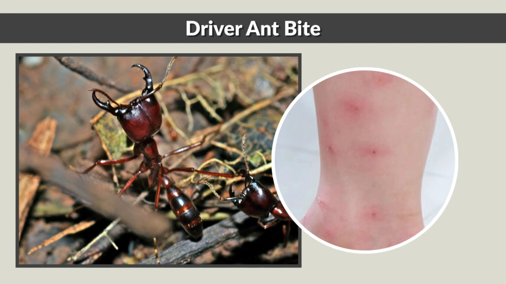 Driver Ant Bite