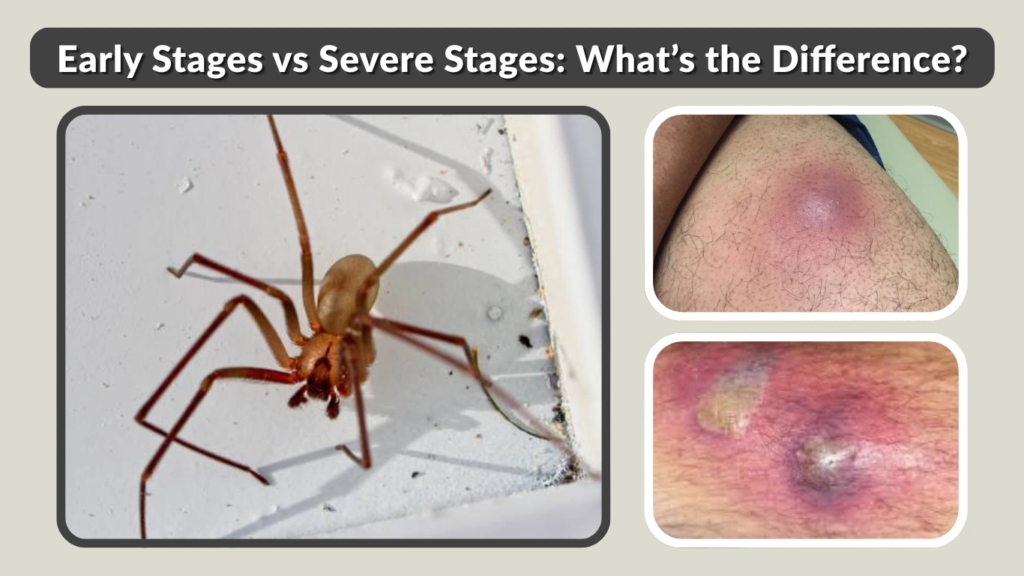 Early Stages vs Severe Stages What’s the Difference