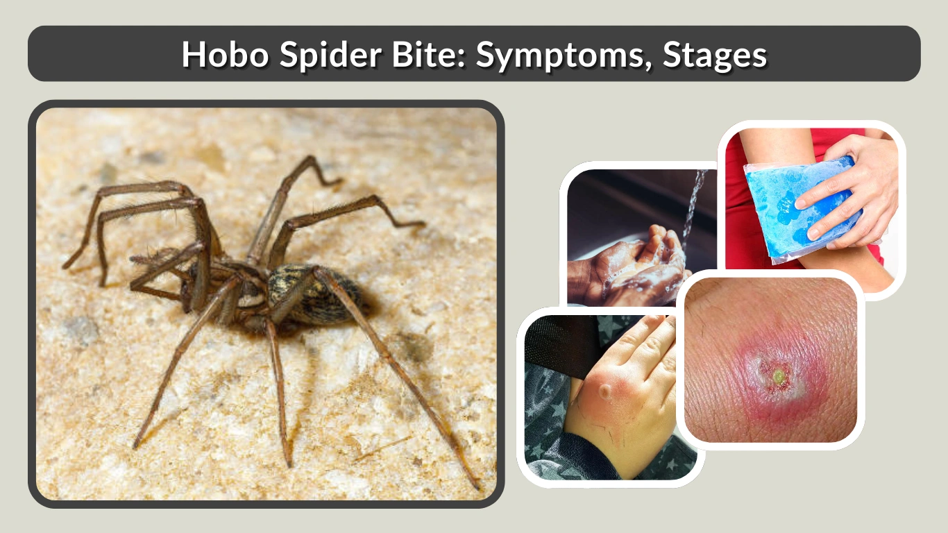 Hobo Spider Bite Symptoms, Stages, and Treatment