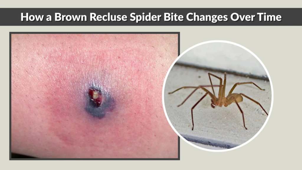 How a Brown Recluse Spider Bite Changes Over Time