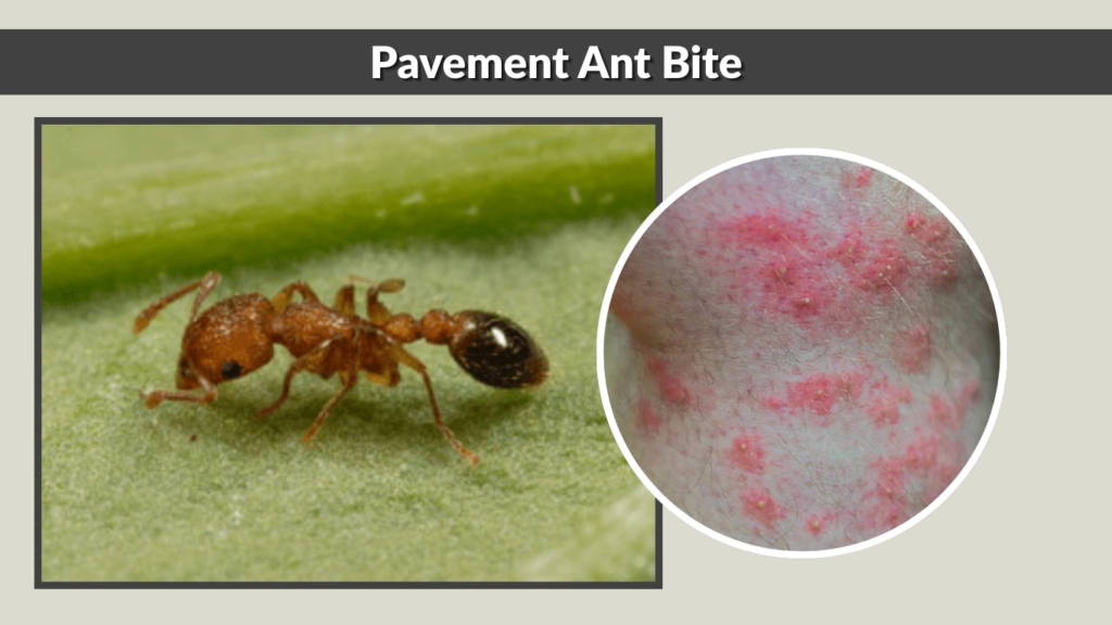 Pavement Ant Bite