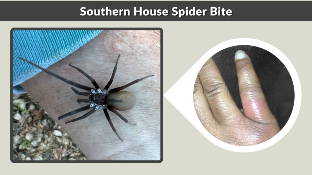 Southern House Spider Bite