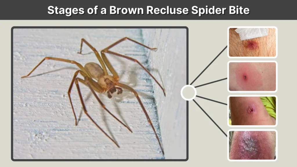 Stages of a Brown Recluse Spider Bite