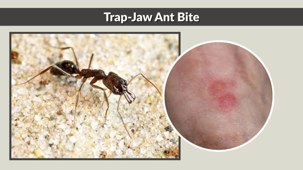 Trap-Jaw Ant Bite