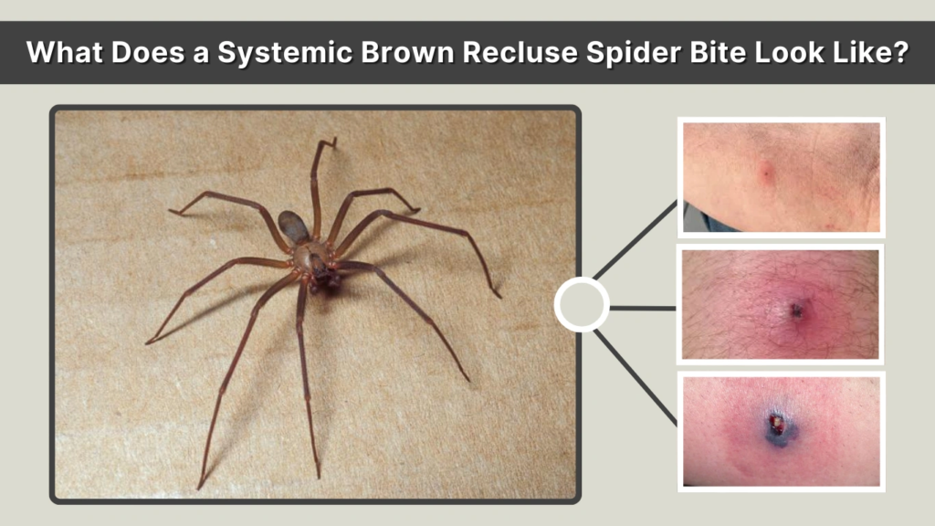 What Does a Systemic Brown Recluse Spider Bite Look Like