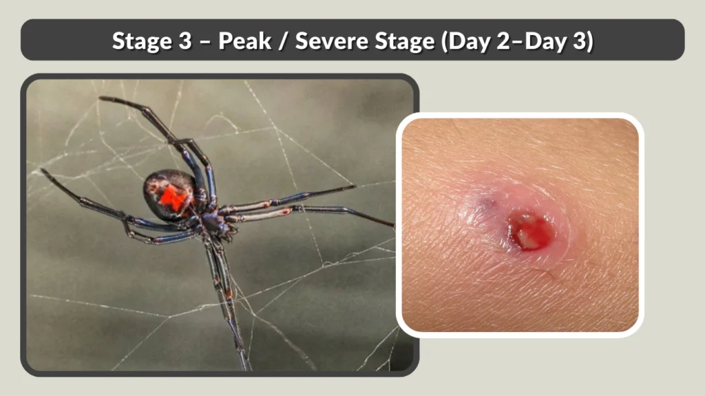 Stage 3 – Peak  Severe Stage (Day 2–Day 3)